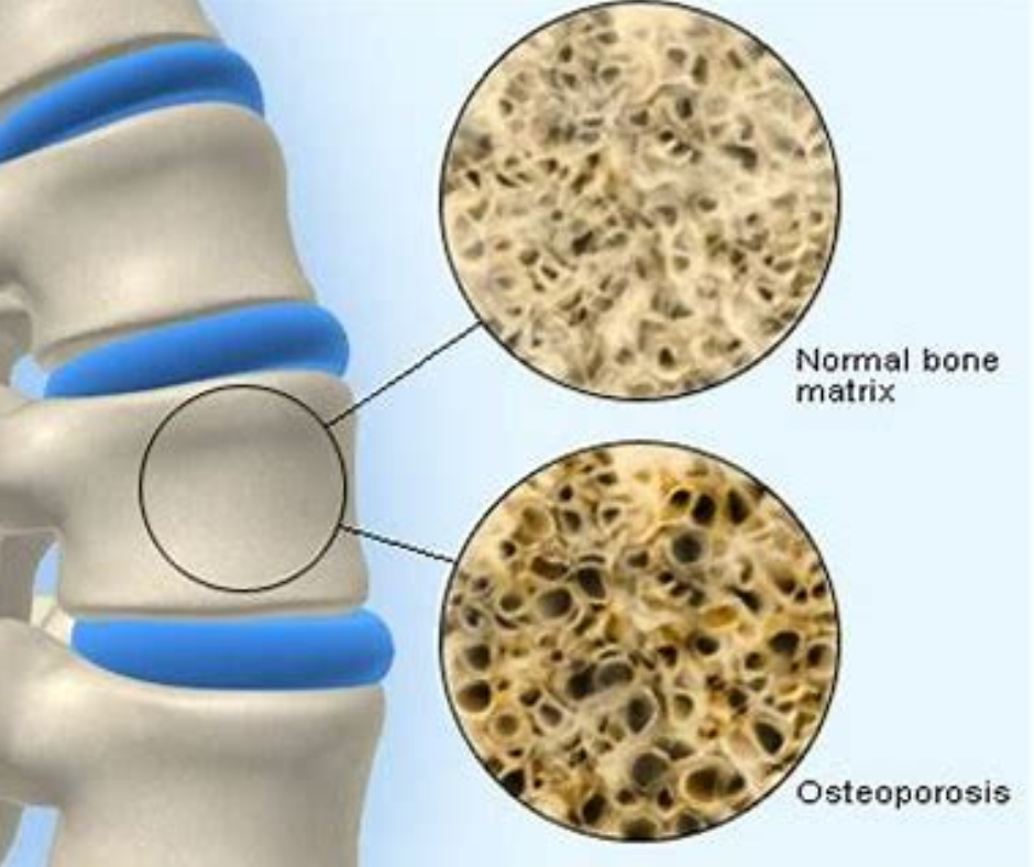 CPD Osteoporosis and Exercise